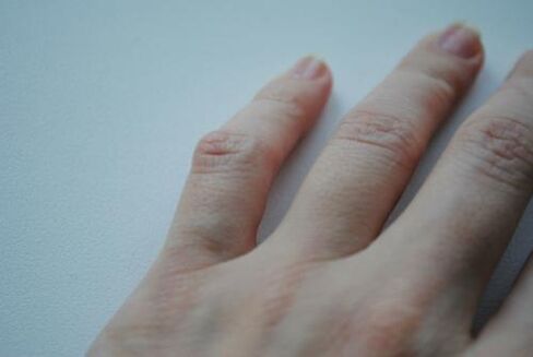 Arthritis tumor appeared on the little finger. 