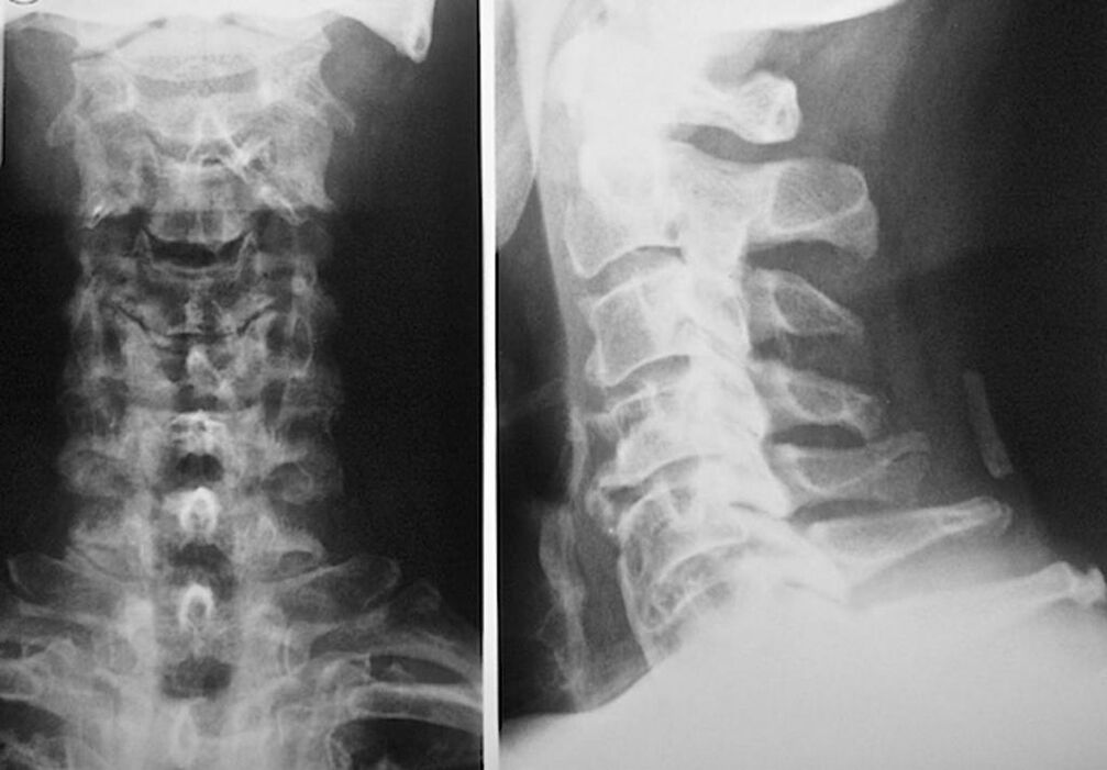 radiography of the cervical spine with osteochondrosis
