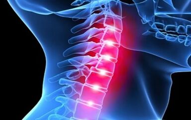Symptoms of the osteocondrosis of cervical waist