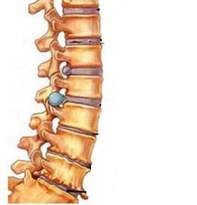 How is the osteocondrosis of the cervical region