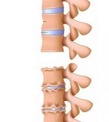 Stages of ramps of the neck osteocondrosis