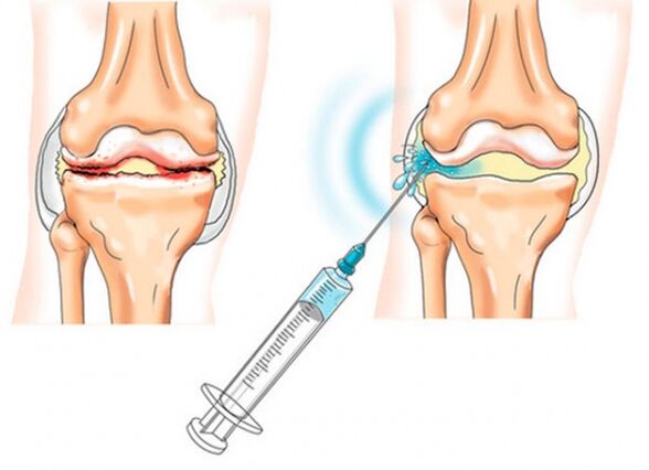 Intraarticular injections for osteoarthritis of the knee