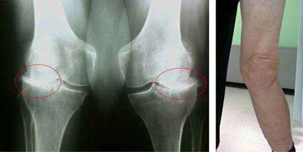 radiography of knee osteoarthritis
